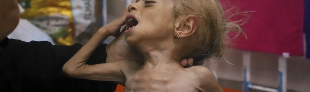 Malnourished kids arrive daily at a Gaza hospital as Netanyahu denies hunger.jpg